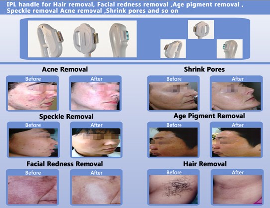 Verticle E-light IPL RF, usuwanie włosów Yag / usuwanie tatuażu kosmetyczka