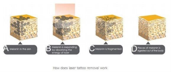 Klinika profesjonalna q przełączać laserowy system usuwania tatuażu laserowego yag z dużą promocją