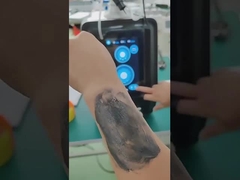 P9 Nd Yag Laser Picosecond Laser Tattoo Removal Device (Urządzenie do usuwania tatuaży laserowej w pikosekundach)